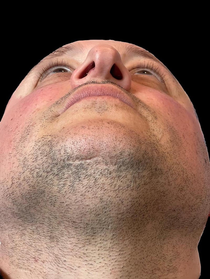 Rhinoplasty Before & After Gallery - Patient 511709 - Image 11