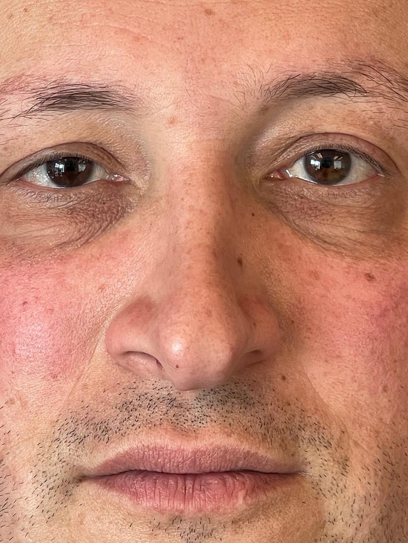 Rhinoplasty Before & After Gallery - Patient 511709 - Image 13