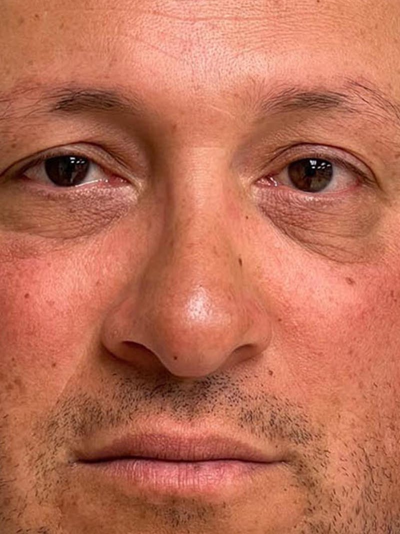Rhinoplasty Before & After Gallery - Patient 511709 - Image 14