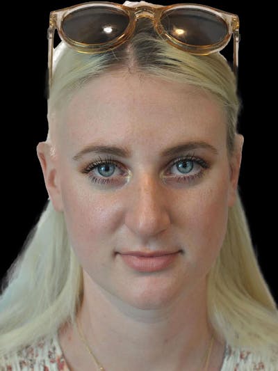 Rhinoplasty Before & After Gallery - Patient 244353 - Image 1