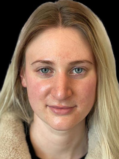 Rhinoplasty Before & After Gallery - Patient 244353 - Image 2
