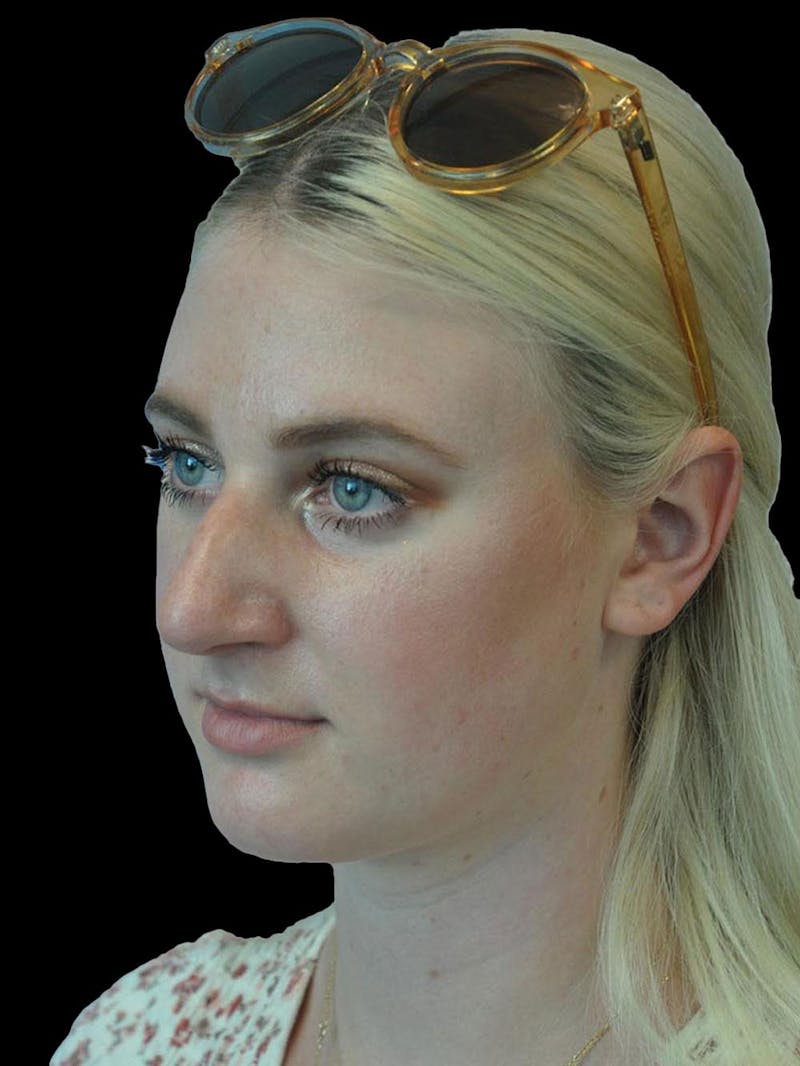 Rhinoplasty Before & After Gallery - Patient 244353 - Image 3