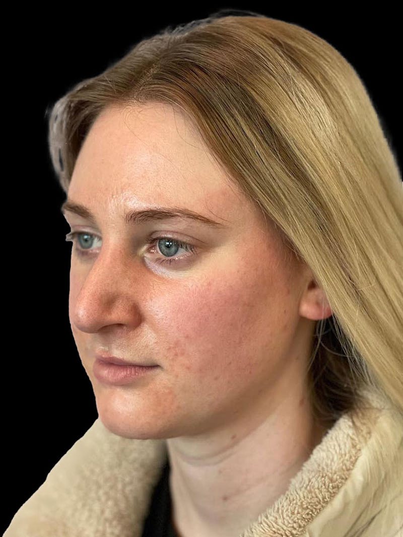 Rhinoplasty Before & After Gallery - Patient 244353 - Image 4