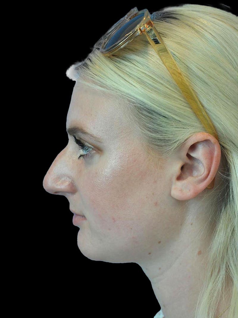 Rhinoplasty Before & After Gallery - Patient 244353 - Image 5