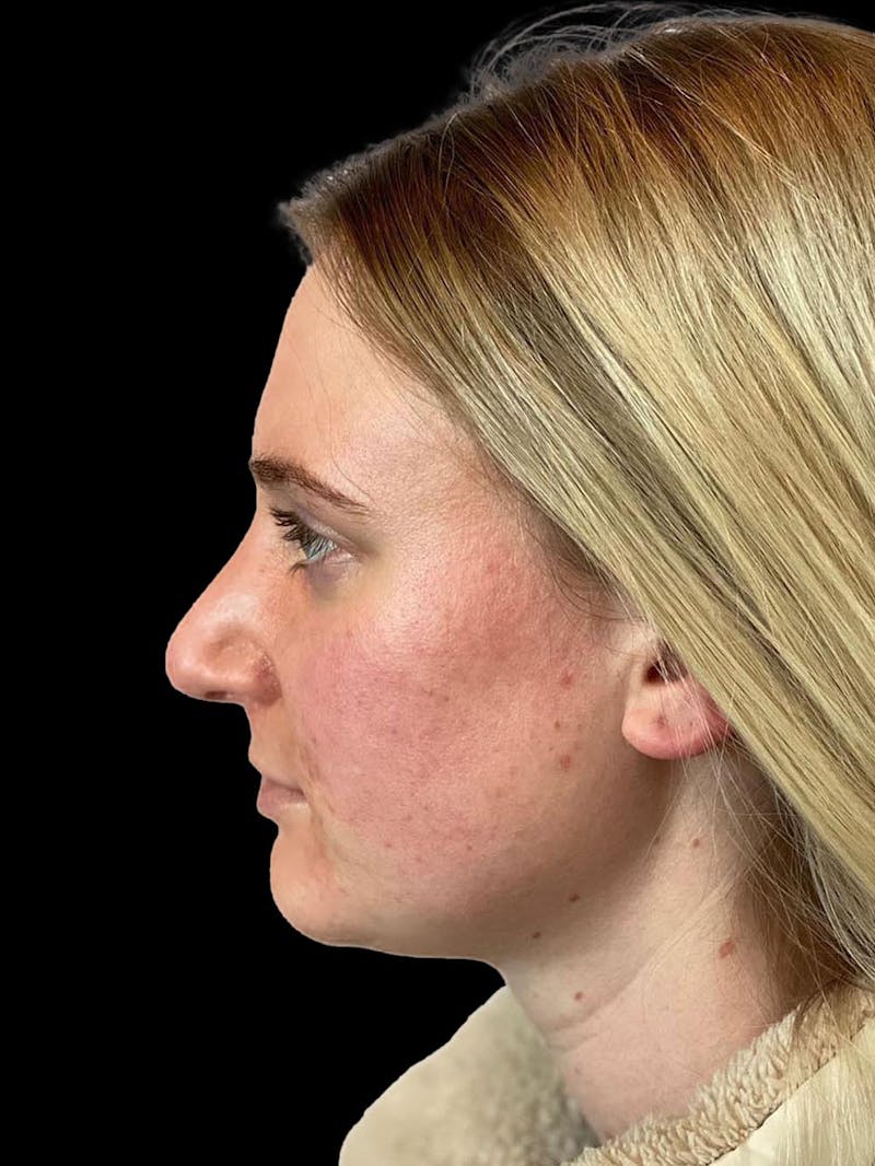 Rhinoplasty Before & After Gallery - Patient 244353 - Image 6