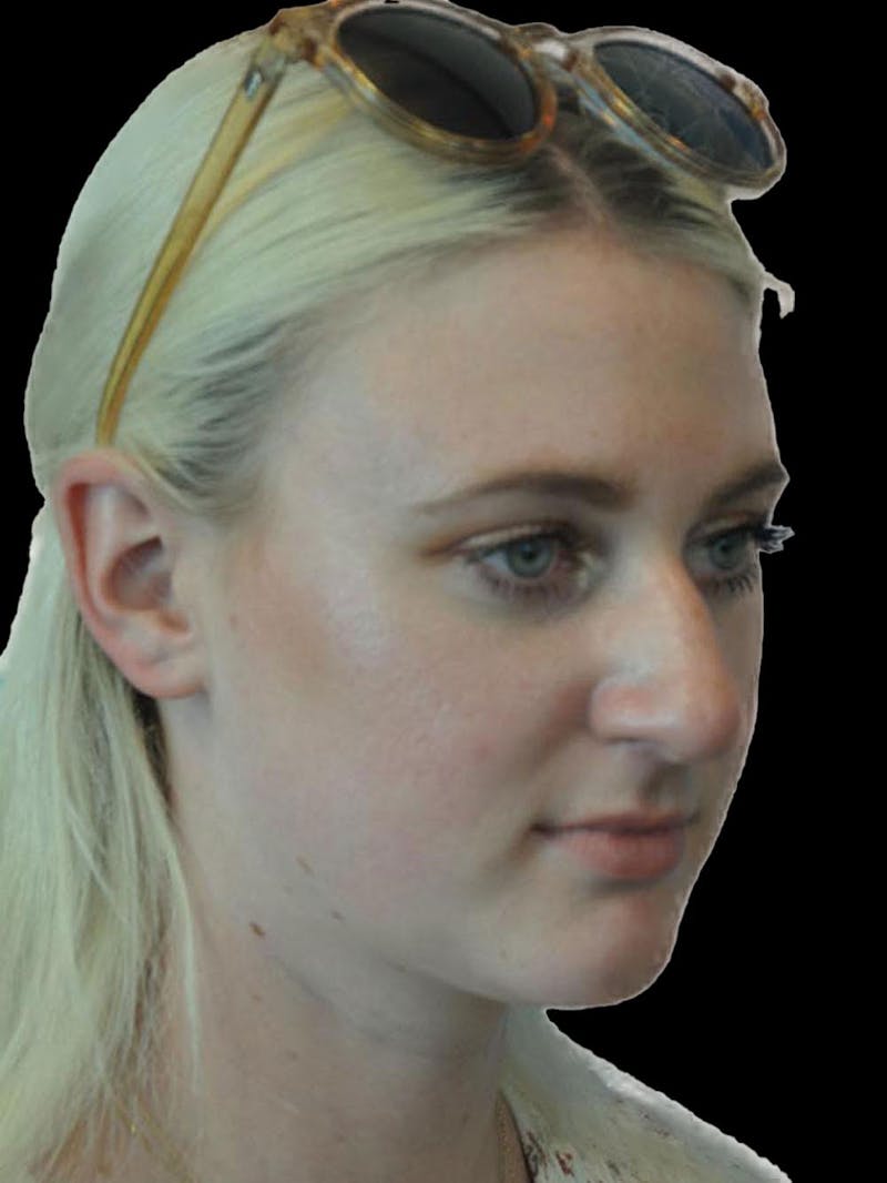 Rhinoplasty Before & After Gallery - Patient 244353 - Image 7