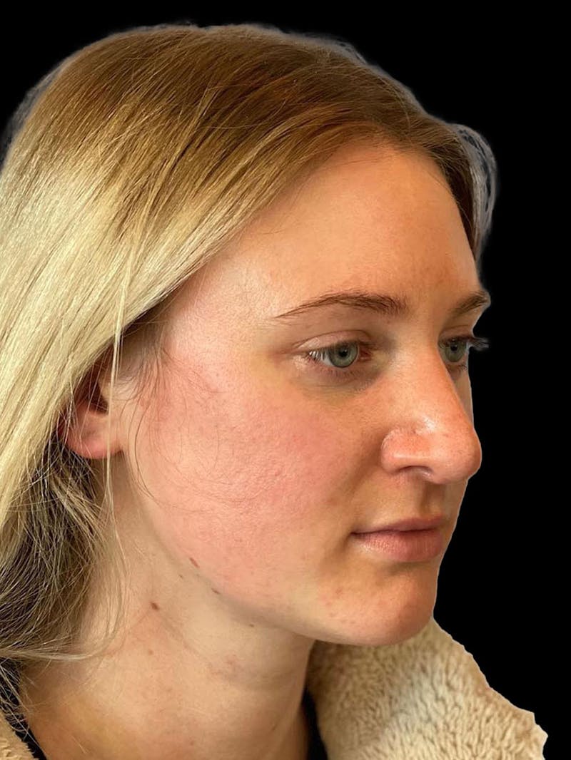 Rhinoplasty Before & After Gallery - Patient 244353 - Image 8