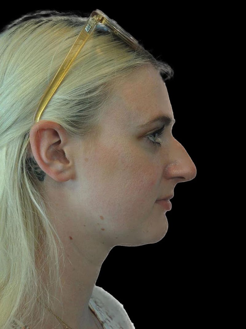 Rhinoplasty Before & After Gallery - Patient 244353 - Image 9
