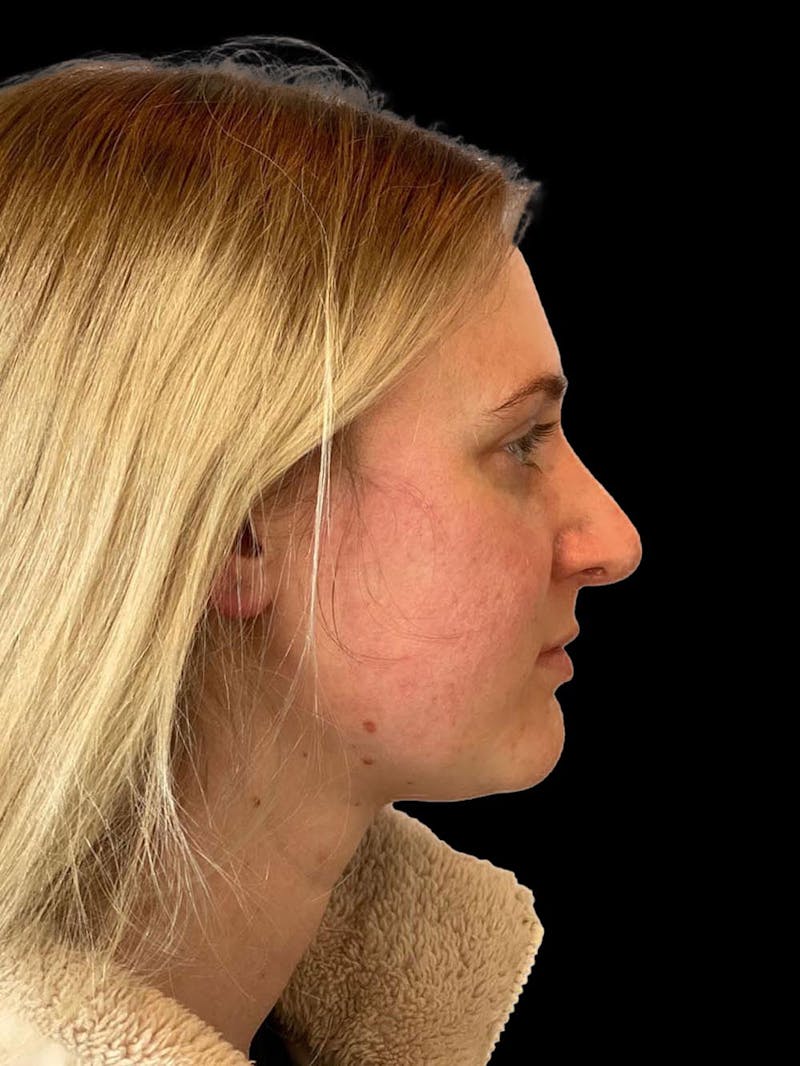 Rhinoplasty Before & After Gallery - Patient 244353 - Image 10