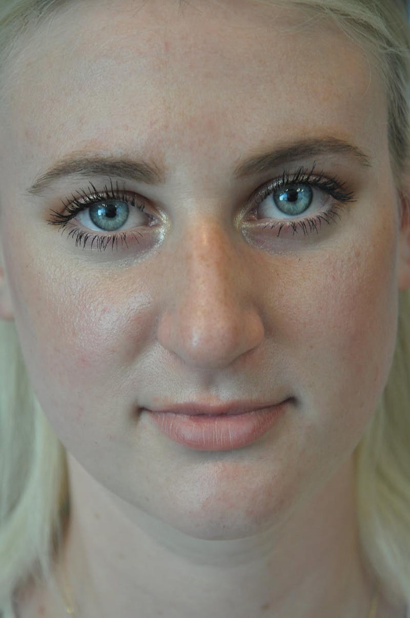Rhinoplasty Before & After Gallery - Patient 244353 - Image 11