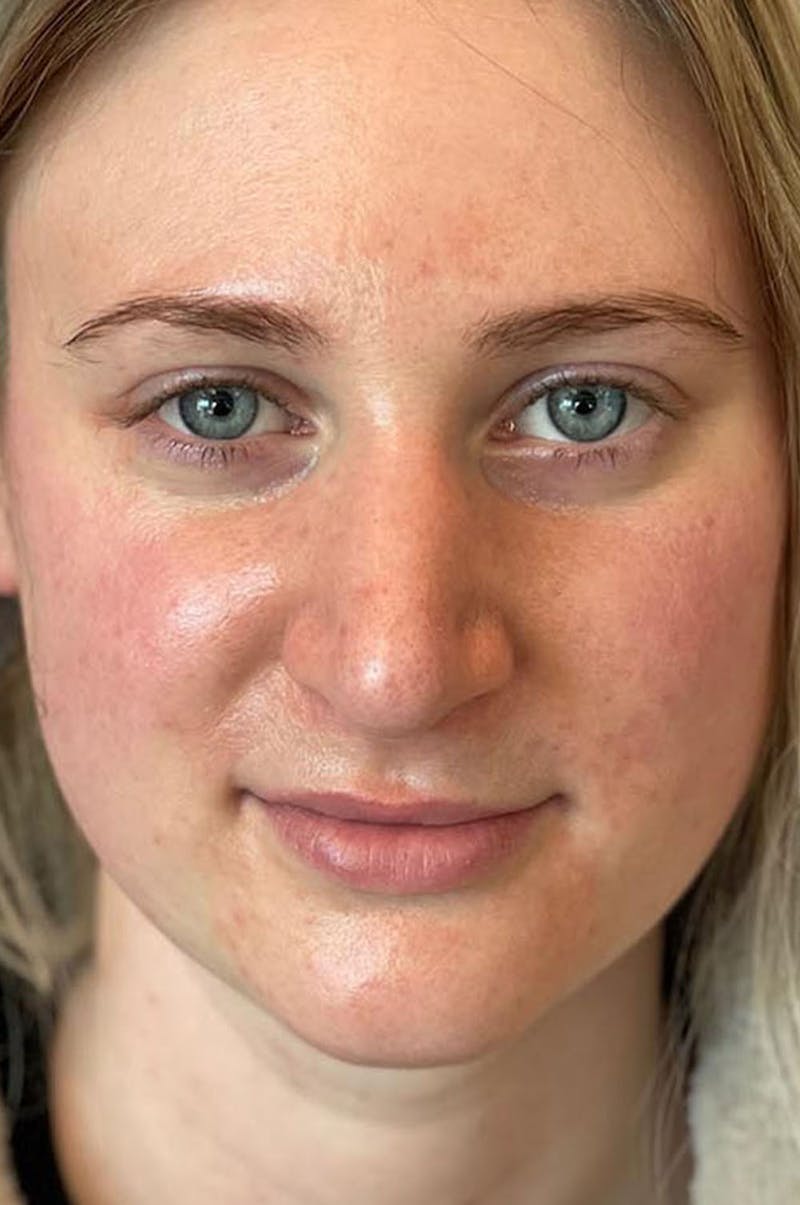 Rhinoplasty Before & After Gallery - Patient 244353 - Image 12