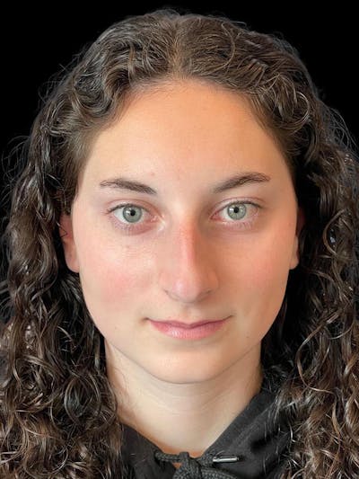 Rhinoplasty Before & After Gallery - Patient 876554 - Image 1