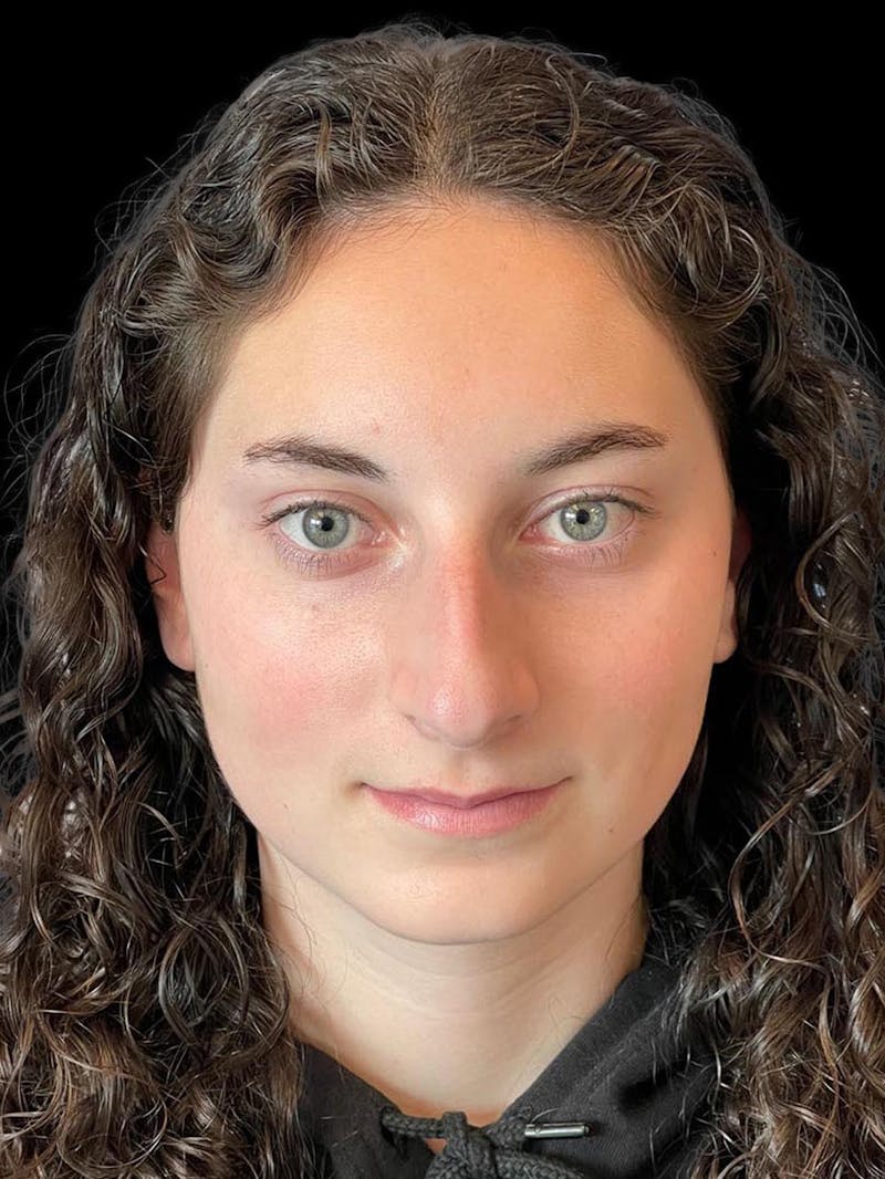 Rhinoplasty Before & After Gallery - Patient 876554 - Image 1