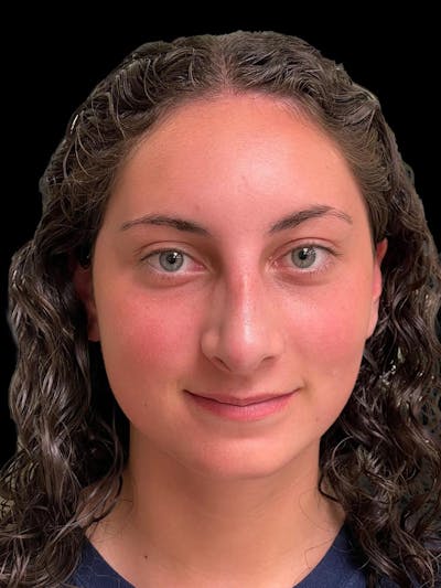 Rhinoplasty Before & After Gallery - Patient 876554 - Image 2