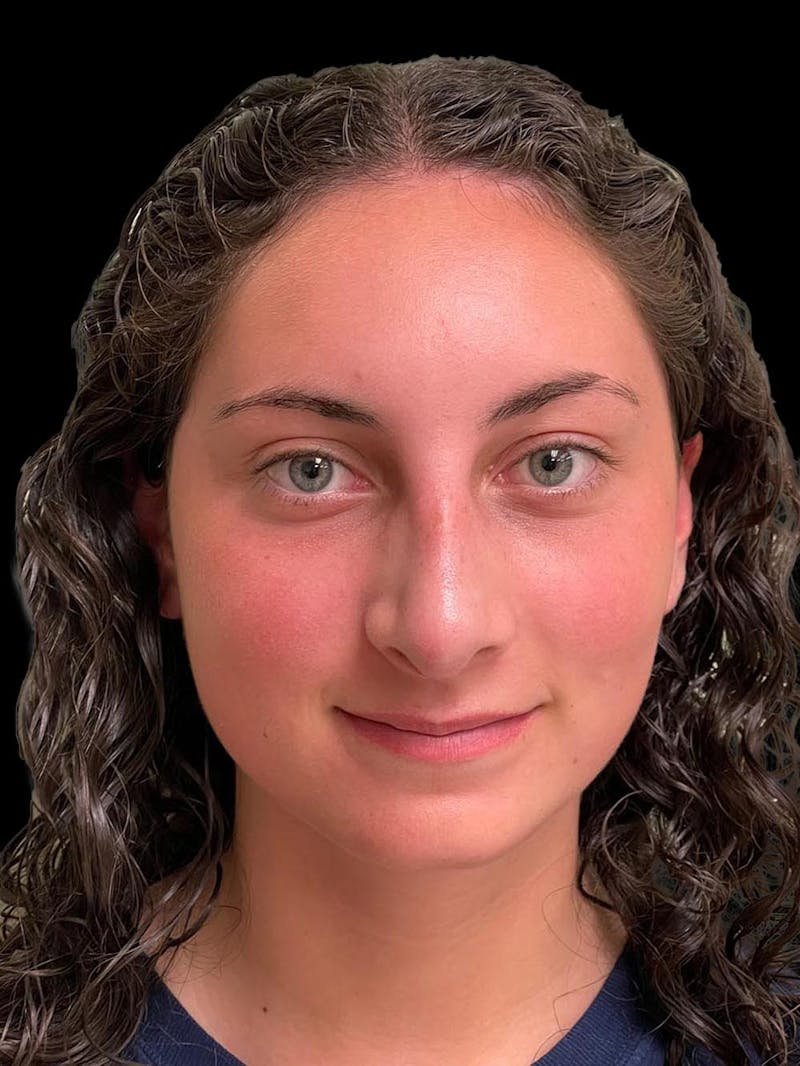 Rhinoplasty Before & After Gallery - Patient 876554 - Image 2