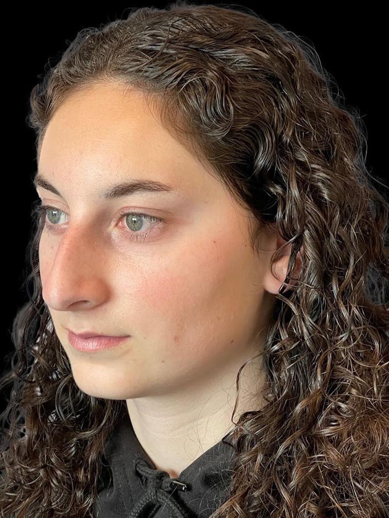 Rhinoplasty Before & After Gallery - Patient 876554 - Image 3