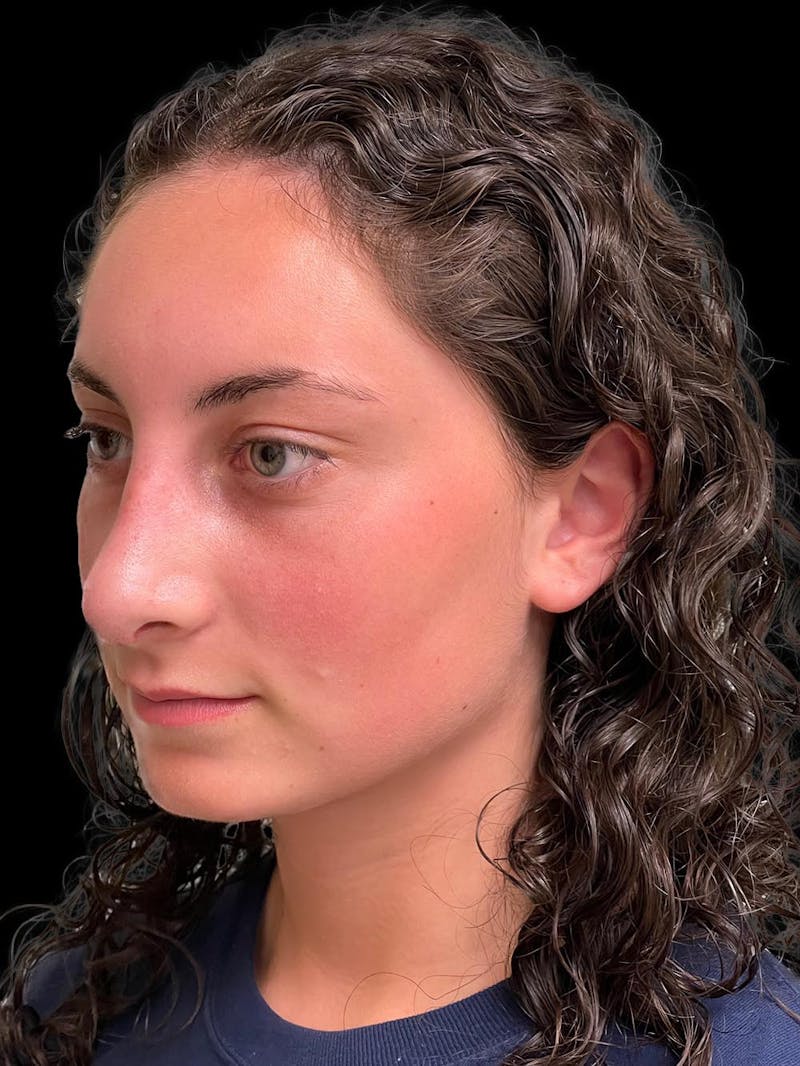 Rhinoplasty Before & After Gallery - Patient 876554 - Image 4
