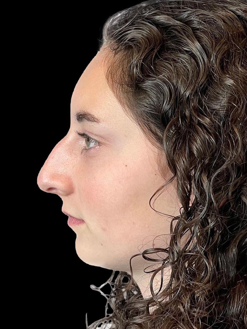 Rhinoplasty Before & After Gallery - Patient 876554 - Image 5