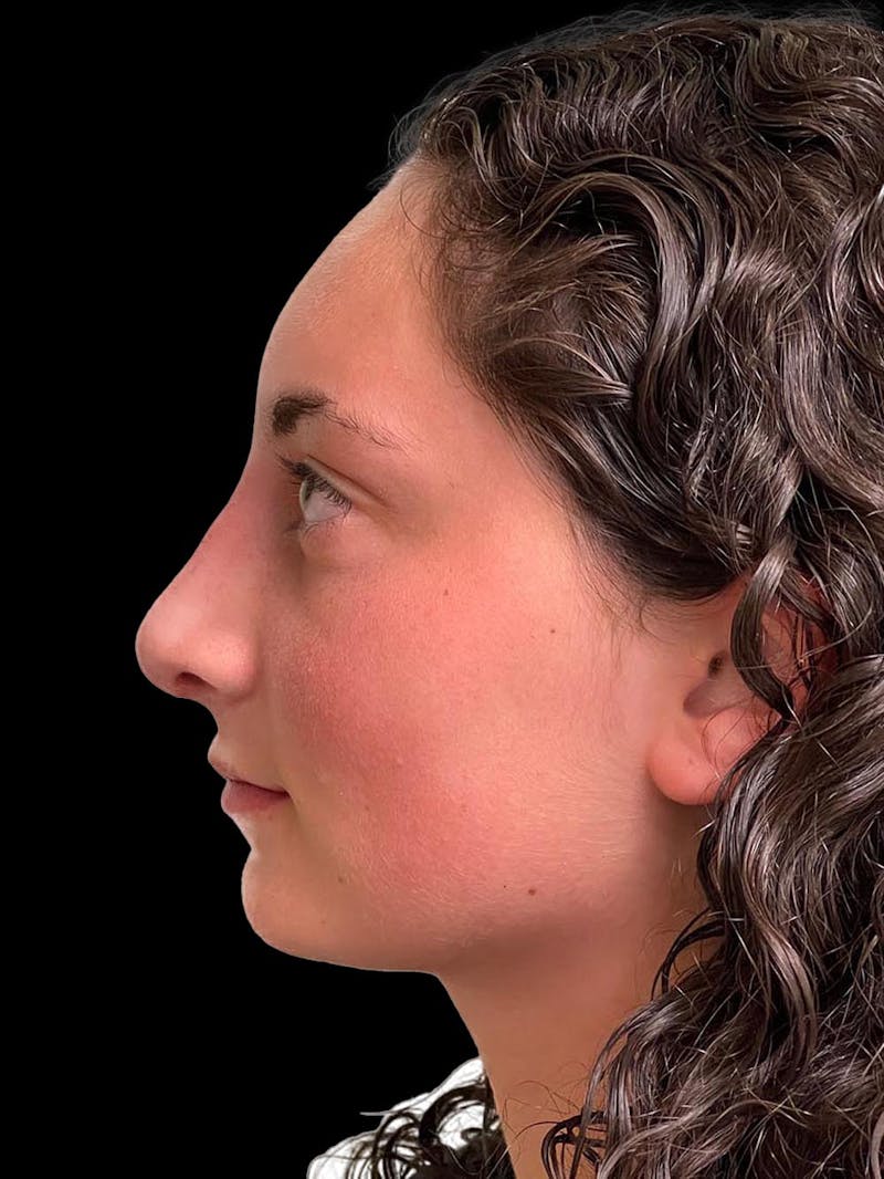 Rhinoplasty Before & After Gallery - Patient 876554 - Image 6