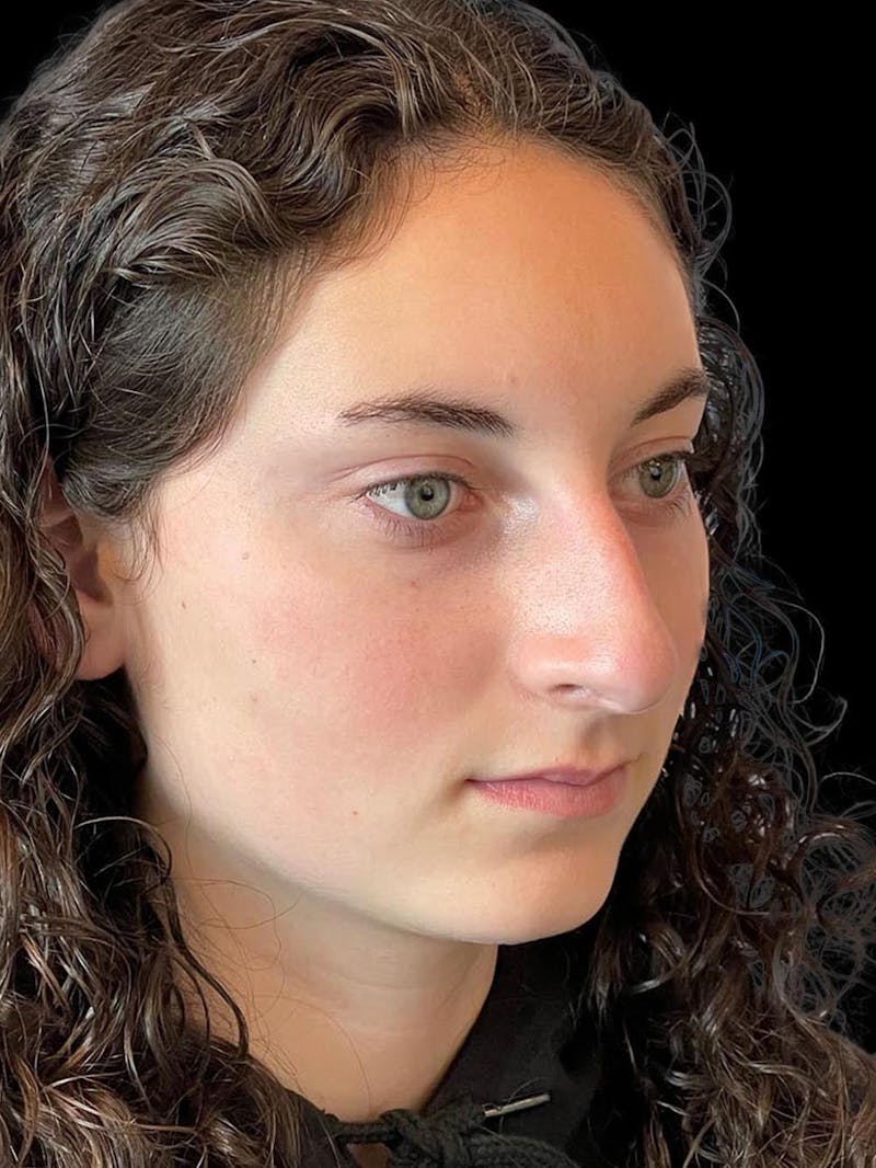 Rhinoplasty Before & After Gallery - Patient 876554 - Image 7