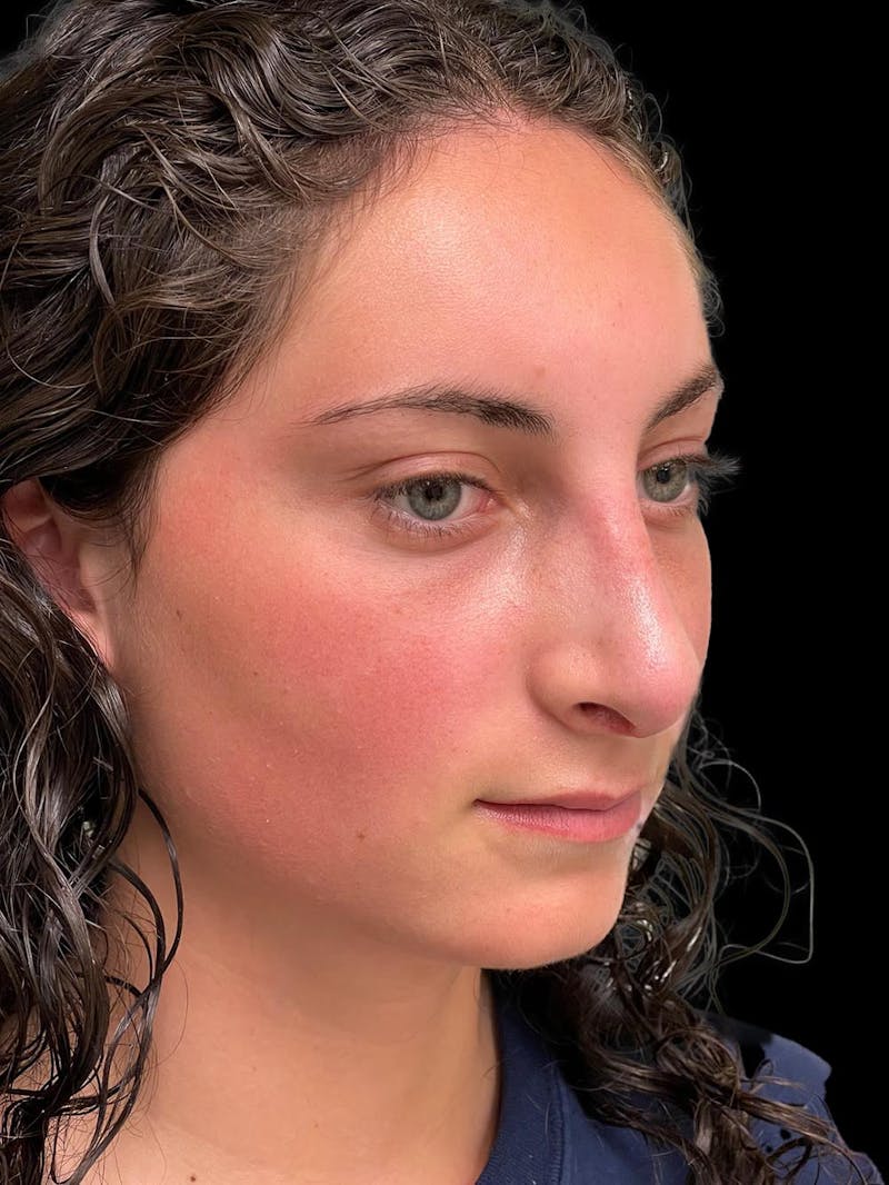 Rhinoplasty Before & After Gallery - Patient 876554 - Image 8