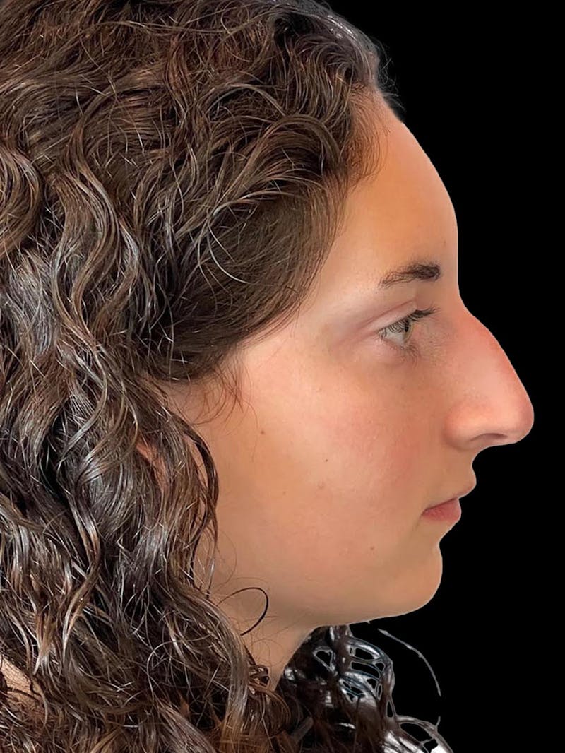 Rhinoplasty Before & After Gallery - Patient 876554 - Image 9