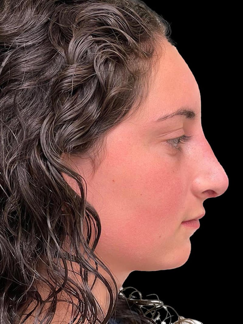 Rhinoplasty Before & After Gallery - Patient 876554 - Image 10