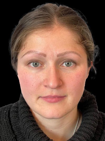 Rhinoplasty Before & After Gallery - Patient 173341 - Image 1