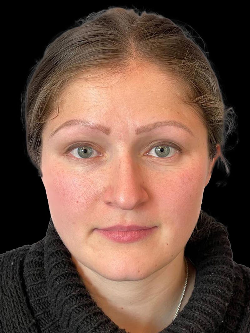 Rhinoplasty Before & After Gallery - Patient 173341 - Image 1