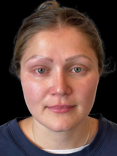 Rhinoplasty Before & After Gallery - Patient 173341 - Image 2
