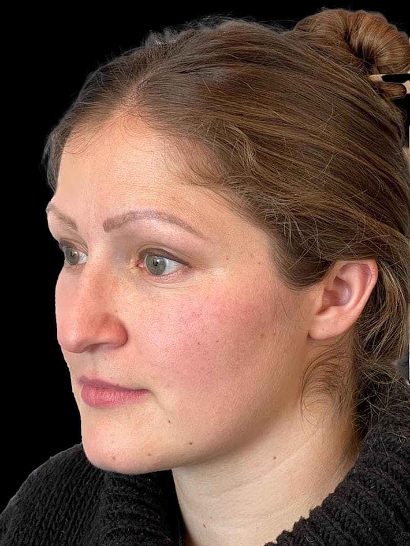 Rhinoplasty Before & After Gallery - Patient 173341 - Image 3
