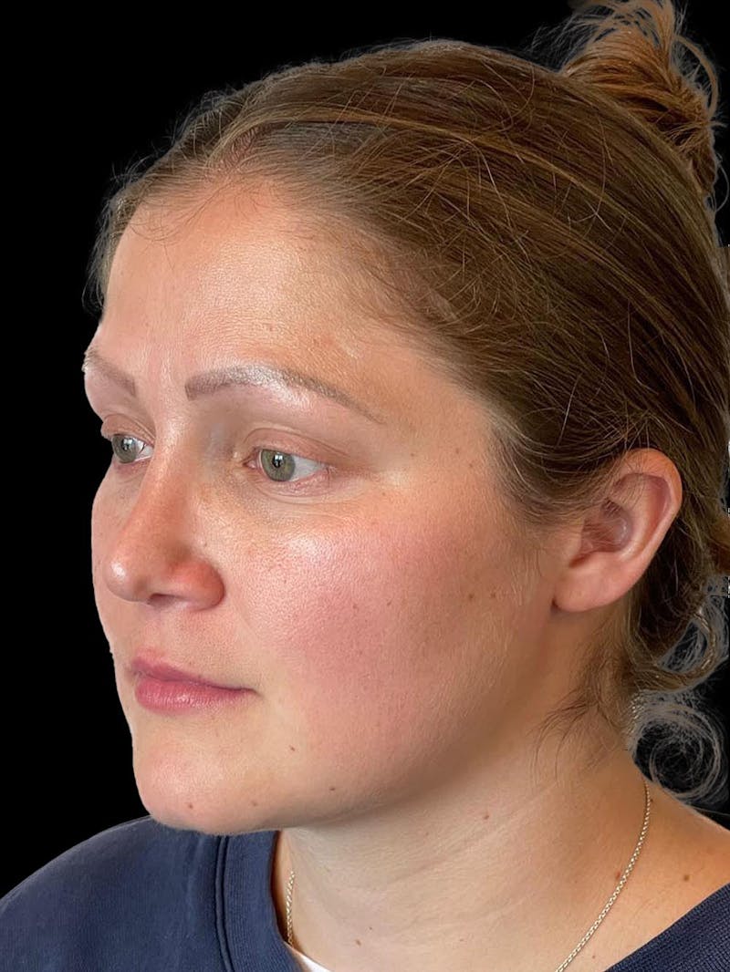 Rhinoplasty Before & After Gallery - Patient 173341 - Image 4