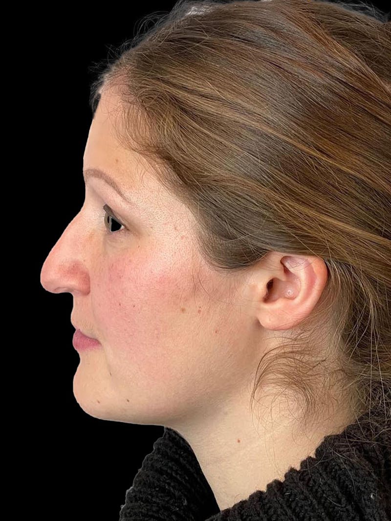 Rhinoplasty Before & After Gallery - Patient 173341 - Image 5