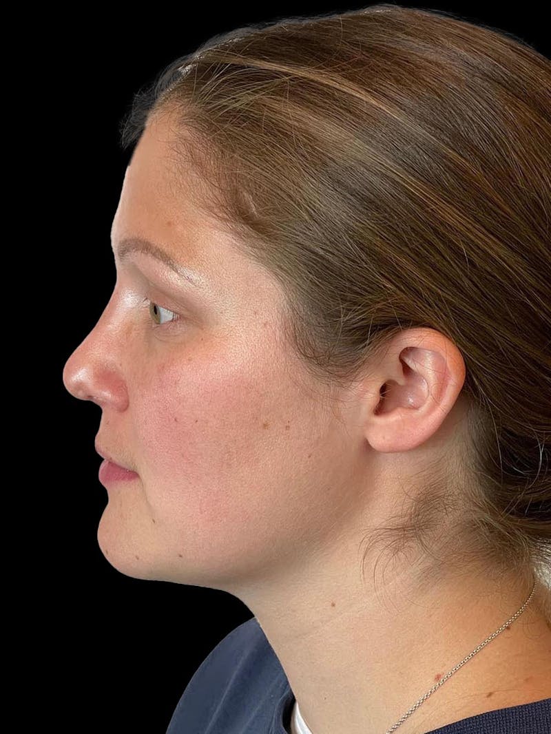 Rhinoplasty Before & After Gallery - Patient 173341 - Image 6