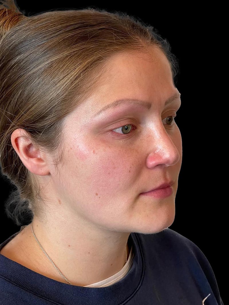 Rhinoplasty Before & After Gallery - Patient 173341 - Image 8