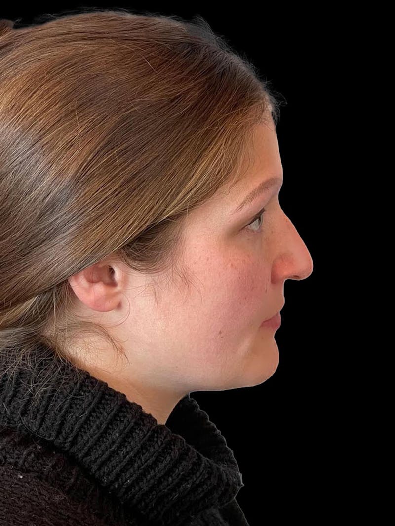 Rhinoplasty Before & After Gallery - Patient 173341 - Image 9