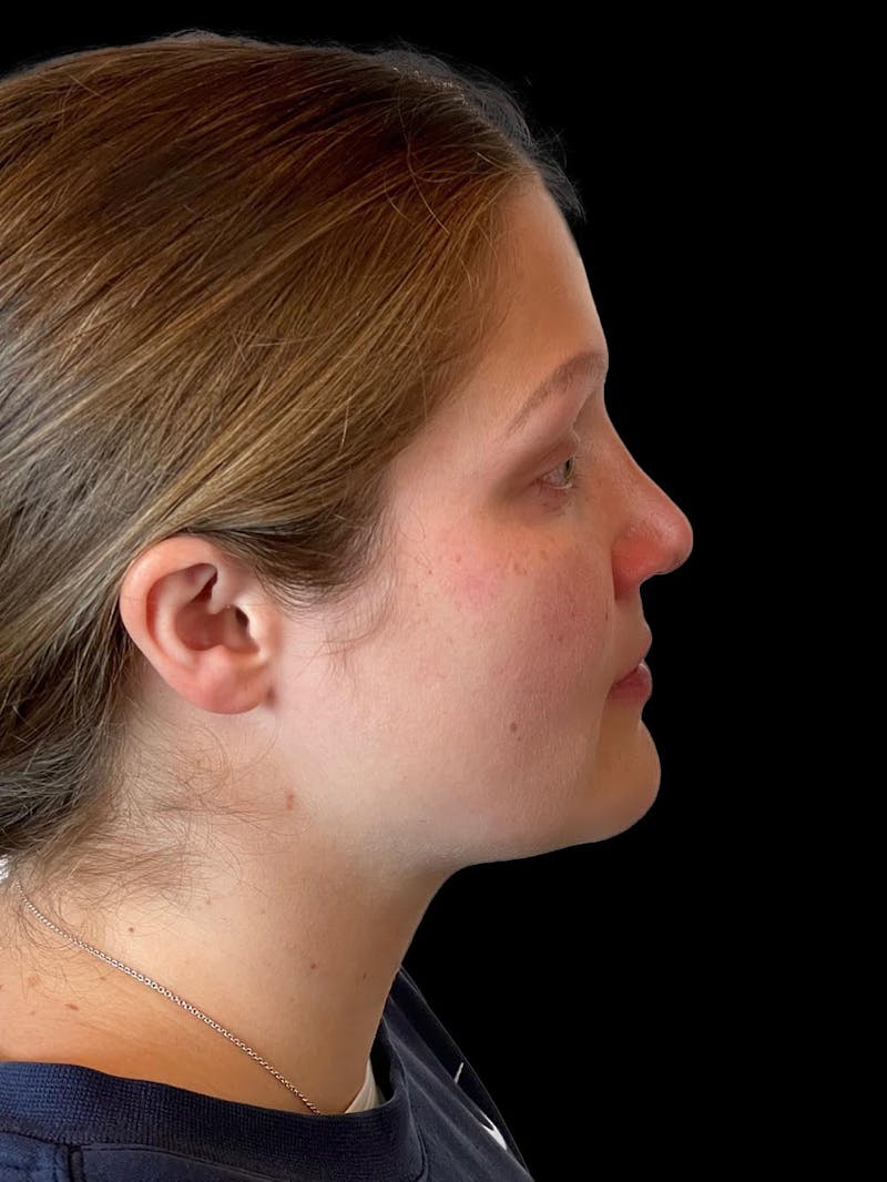 Rhinoplasty Before & After Gallery - Patient 173341 - Image 10