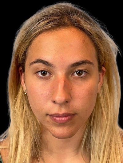 Rhinoplasty Before & After Gallery - Patient 211594 - Image 1