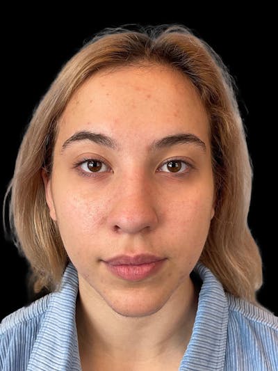Rhinoplasty Before & After Gallery - Patient 211594 - Image 2