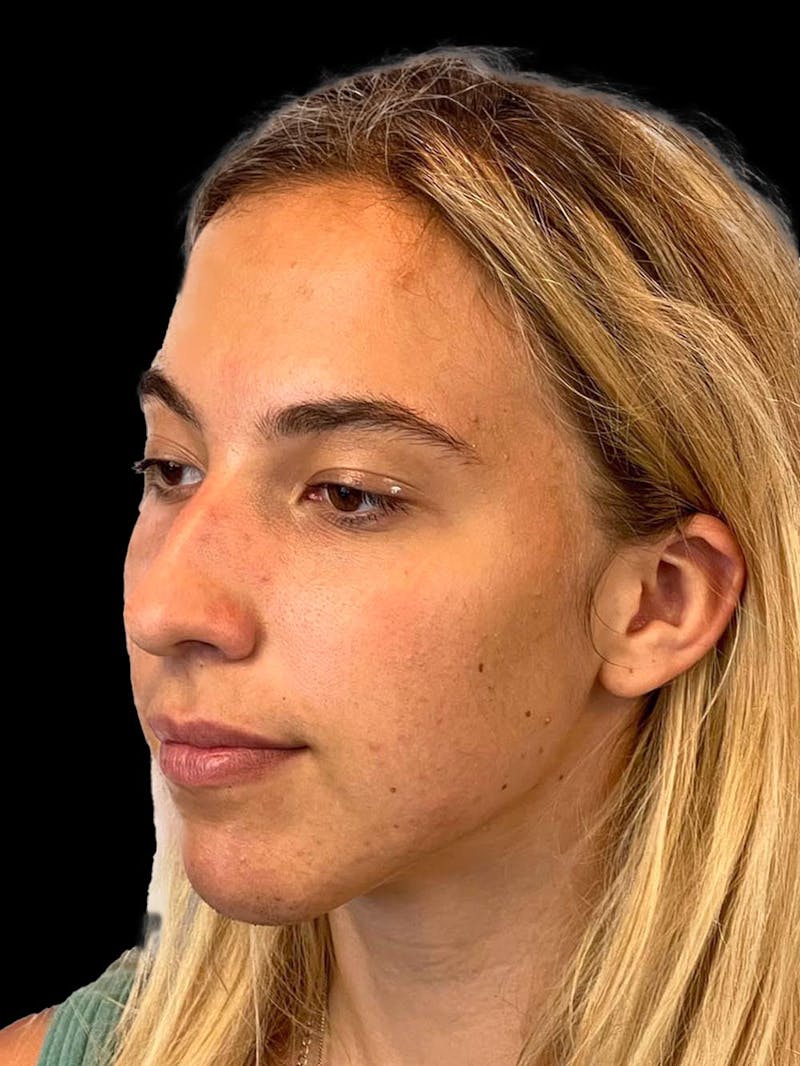 Rhinoplasty Before & After Gallery - Patient 211594 - Image 3