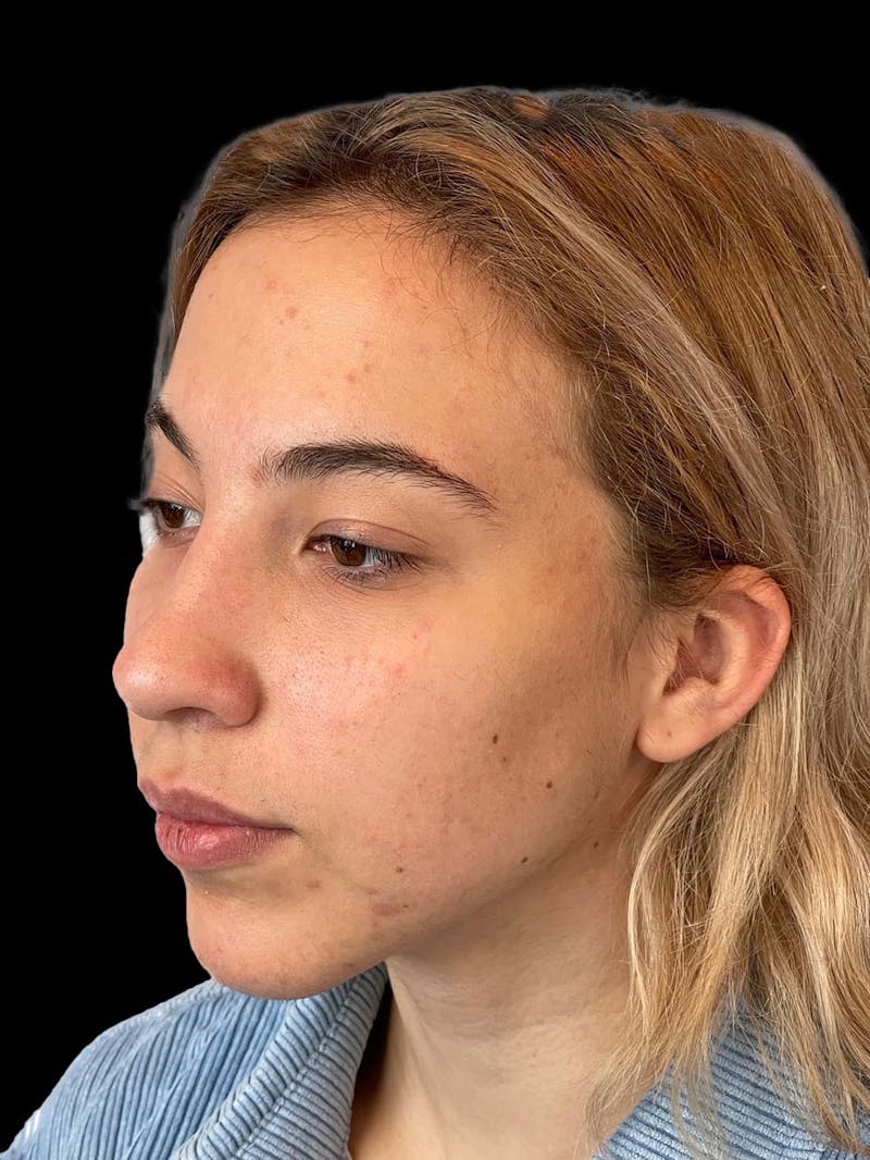 Rhinoplasty Before & After Gallery - Patient 211594 - Image 4