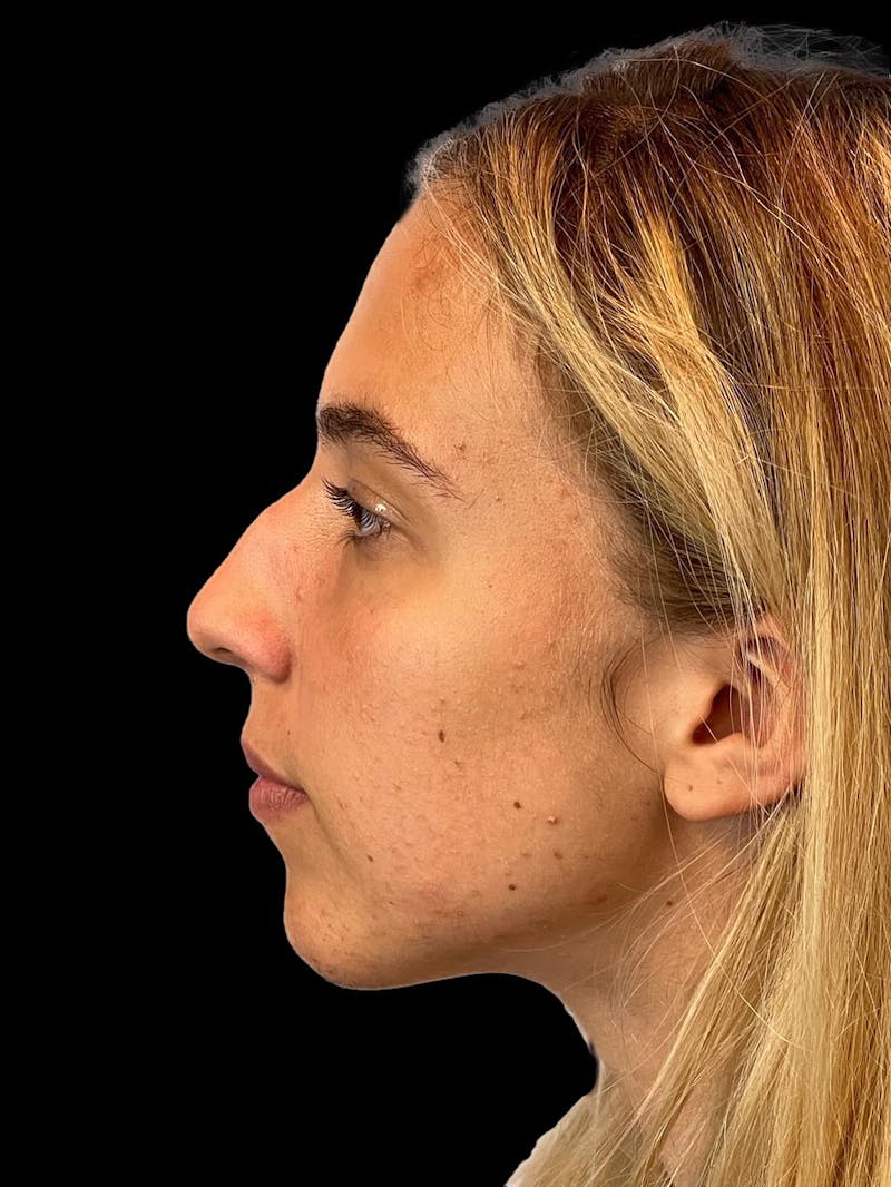 Rhinoplasty Before & After Gallery - Patient 211594 - Image 5