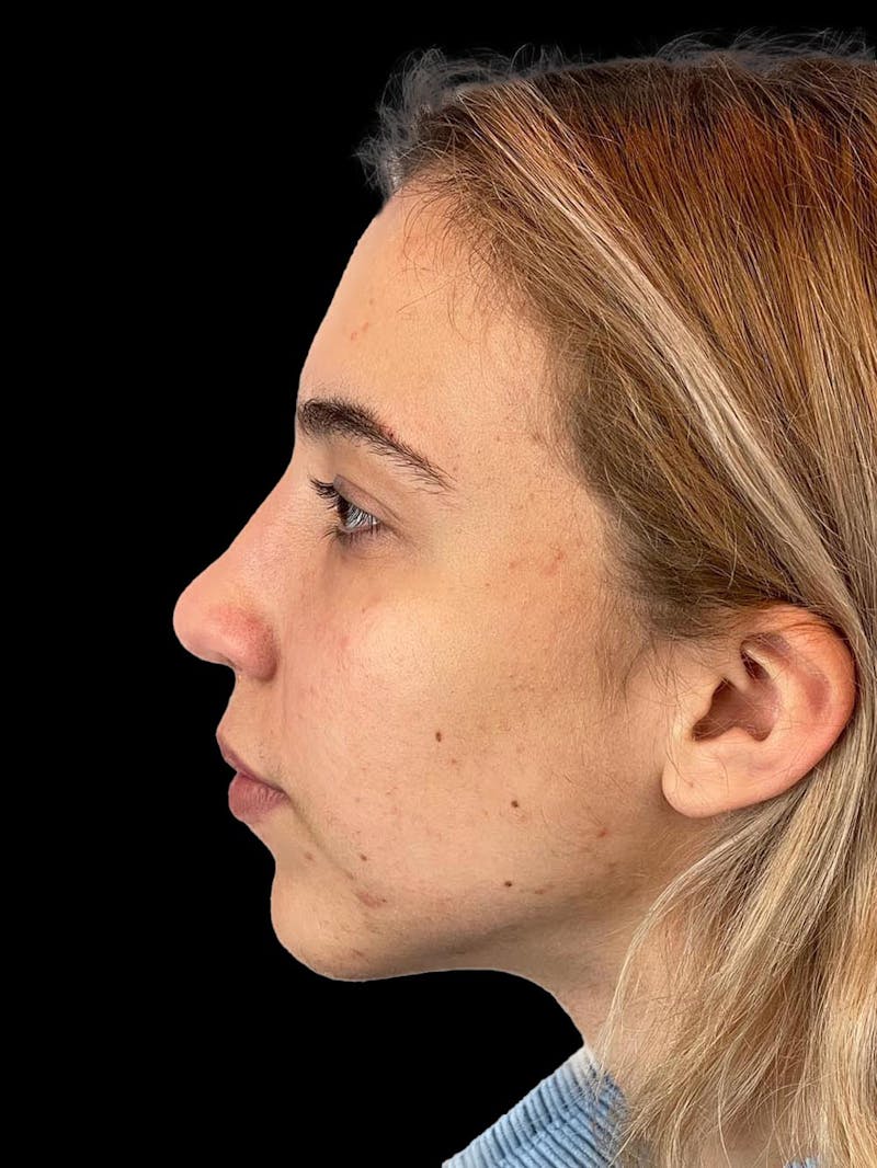 Rhinoplasty Before & After Gallery - Patient 211594 - Image 6