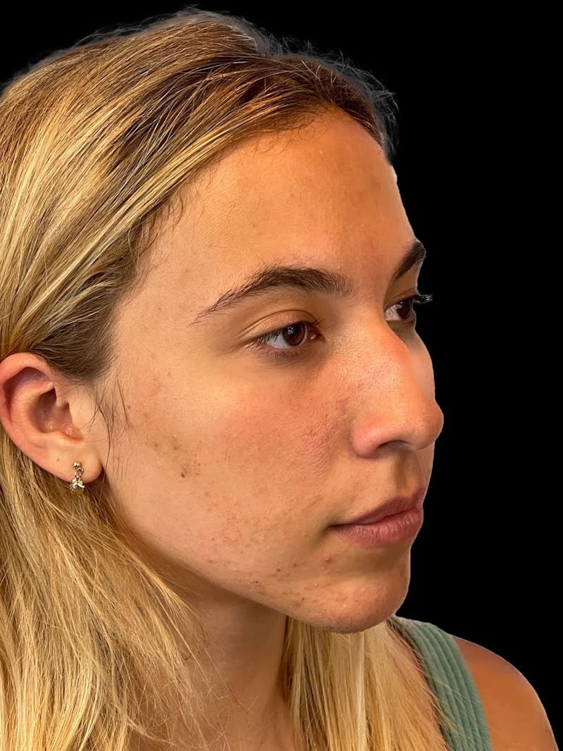Rhinoplasty Before & After Gallery - Patient 211594 - Image 7
