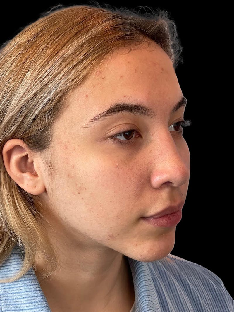 Rhinoplasty Before & After Gallery - Patient 211594 - Image 8