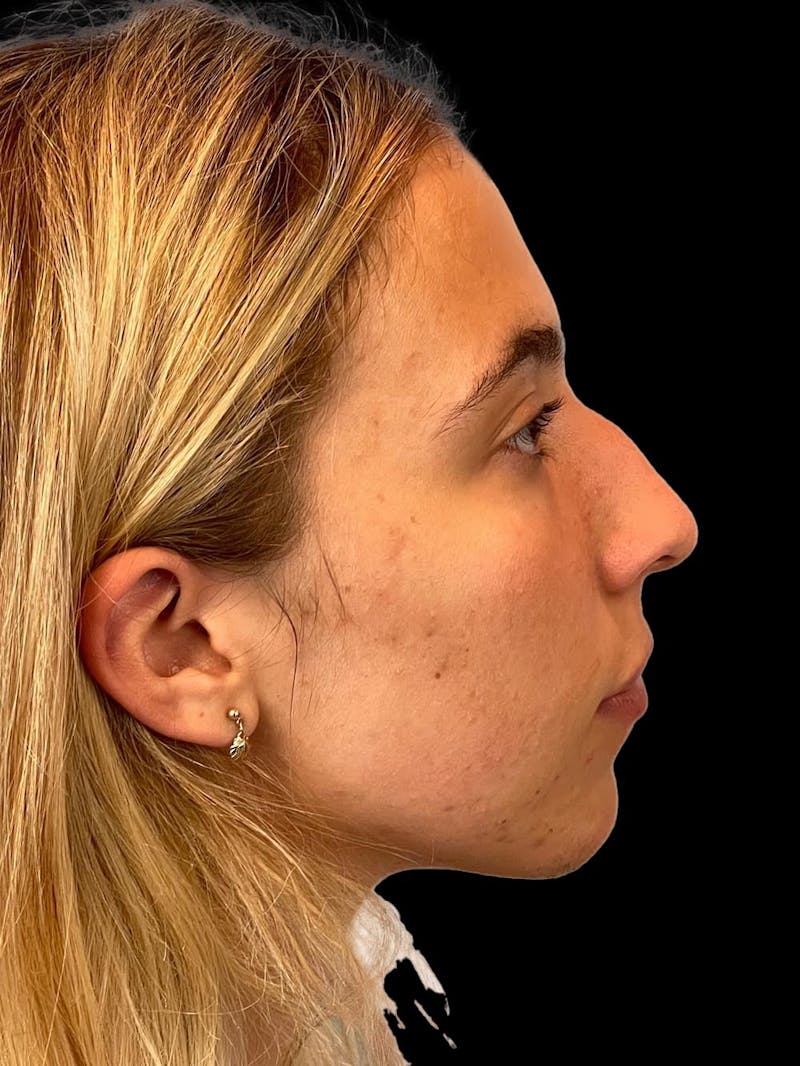 Rhinoplasty Before & After Gallery - Patient 211594 - Image 9
