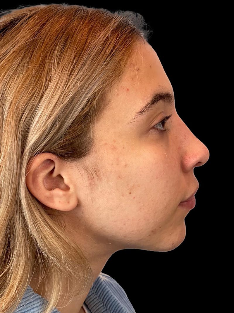 Rhinoplasty Before & After Gallery - Patient 211594 - Image 10
