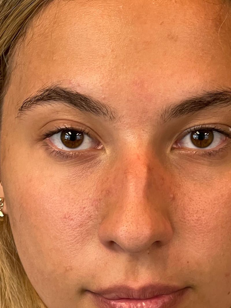 Rhinoplasty Before & After Gallery - Patient 211594 - Image 11