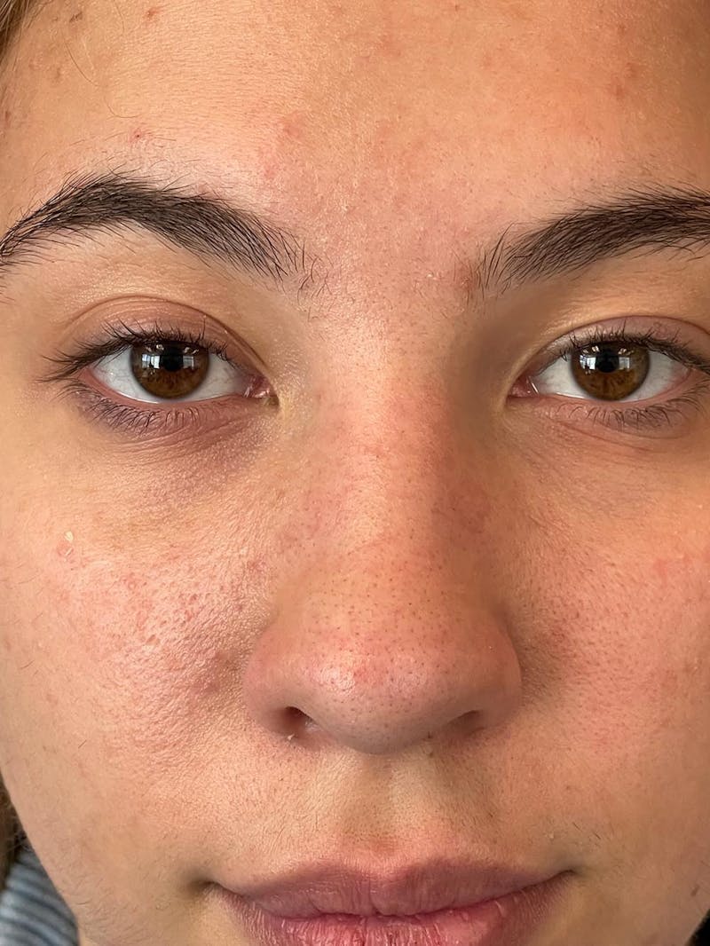 Rhinoplasty Before & After Gallery - Patient 211594 - Image 12