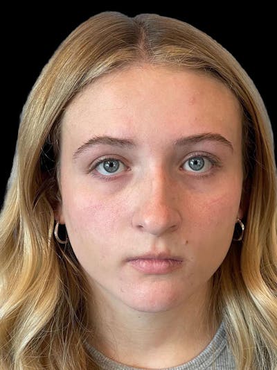 Rhinoplasty Before & After Gallery - Patient 315883 - Image 1